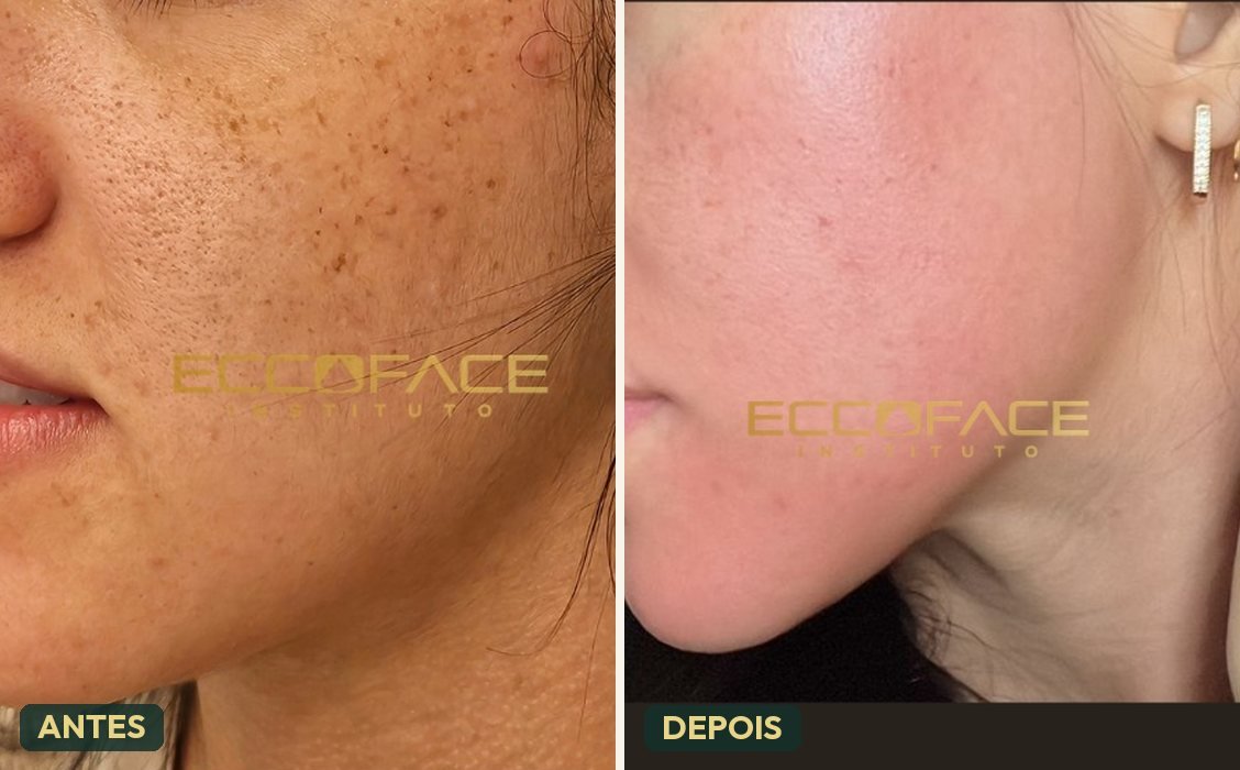 Protocolo EccoRegen — antes e depois de uniformização de manchas e regeneração da pele