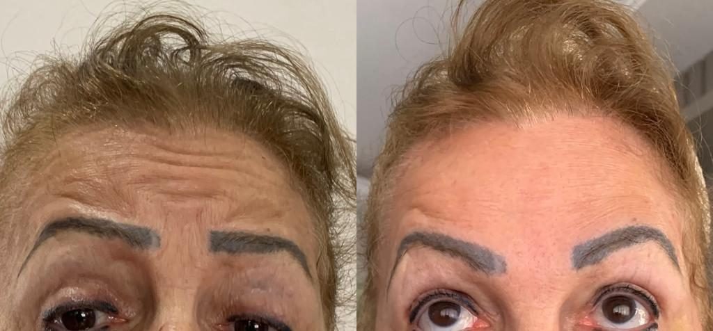 Toxina botulínica: antes e depois na testa